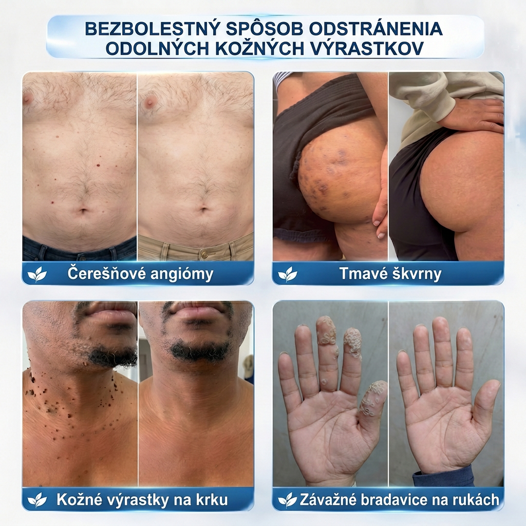 𝑶𝒇𝒊𝒄𝒊á𝒍𝒏𝒚 𝒐𝒃𝒄𝒉𝒐𝒅 ✅️ | 𝐇𝐈𝐒𝐊𝐈𝐍® 7-𝒅ň𝒐𝒗ý 𝒑𝒓í𝒑𝒓𝒂𝒗𝒐𝒌 𝒏𝒂 𝒐𝒅𝒔𝒕𝒓á𝒏𝒆𝒏𝒊𝒆 𝒌𝒐ž𝒏ý𝒄𝒉 𝒗ý𝒓𝒂𝒔𝒕𝒌𝒐𝒗 𝒂 𝒑𝒊𝒈𝒎𝒆𝒏𝒕𝒐𝒗ý𝒄𝒉 š𝒌𝒗ŕ𝒏👩‍⚕️ (𝒃𝒆𝒛 𝒃𝒐𝒍𝒆𝒔𝒕𝒊, 𝒃𝒆𝒛 𝒋𝒂𝒛𝒊𝒆𝒗, 𝒑𝒓𝒆𝒔𝒏ý 𝒓𝒐𝒍𝒍-𝒐𝒏 𝒂𝒑𝒍𝒊𝒌á𝒕𝒐𝒓) 🔥