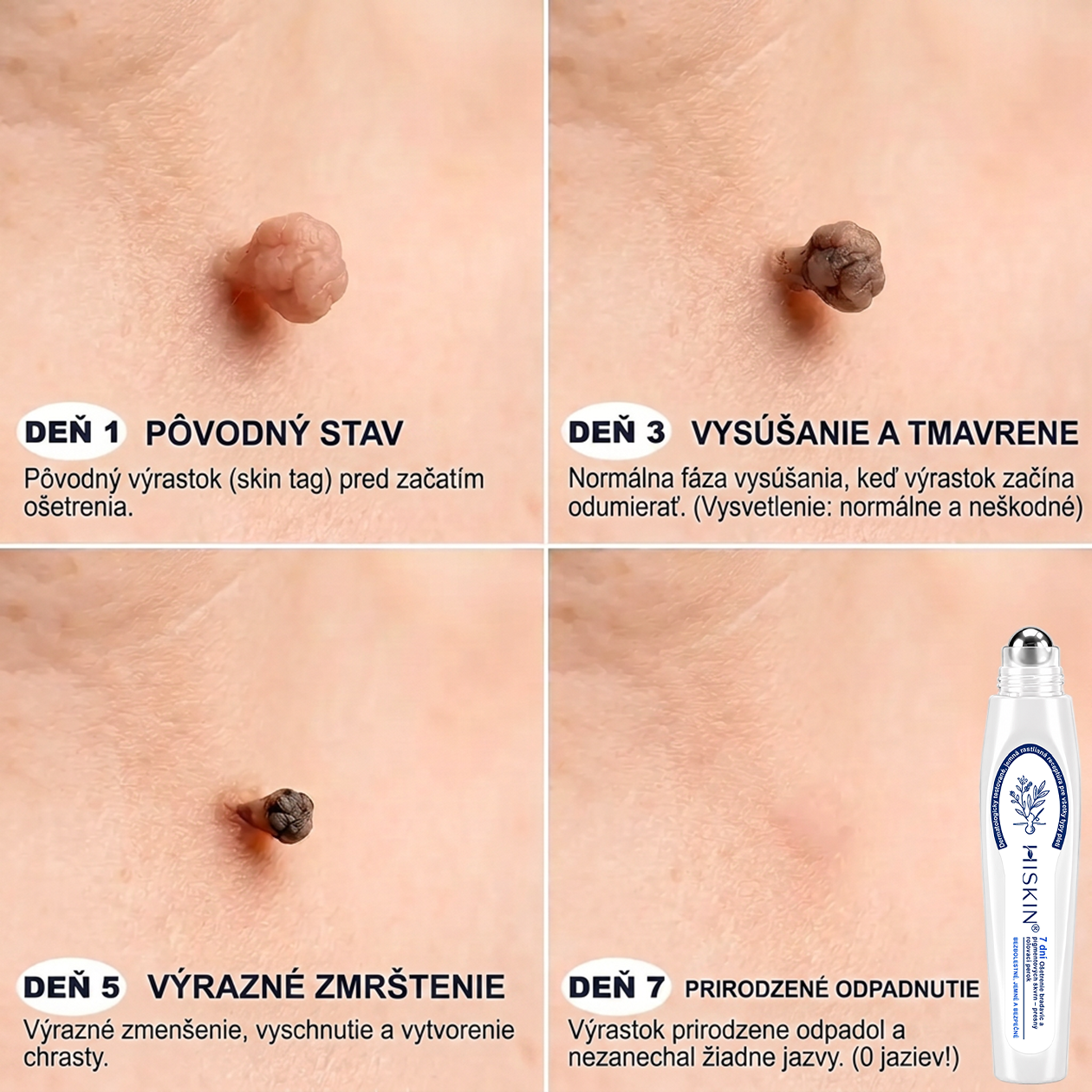 𝑶𝒇𝒊𝒄𝒊á𝒍𝒏𝒚 𝒐𝒃𝒄𝒉𝒐𝒅 ✅️ | 𝐇𝐈𝐒𝐊𝐈𝐍® 7-𝒅ň𝒐𝒗ý 𝒑𝒓í𝒑𝒓𝒂𝒗𝒐𝒌 𝒏𝒂 𝒐𝒅𝒔𝒕𝒓á𝒏𝒆𝒏𝒊𝒆 𝒌𝒐ž𝒏ý𝒄𝒉 𝒗ý𝒓𝒂𝒔𝒕𝒌𝒐𝒗 𝒂 𝒑𝒊𝒈𝒎𝒆𝒏𝒕𝒐𝒗ý𝒄𝒉 š𝒌𝒗ŕ𝒏👩‍⚕️ (𝒃𝒆𝒛 𝒃𝒐𝒍𝒆𝒔𝒕𝒊, 𝒃𝒆𝒛 𝒋𝒂𝒛𝒊𝒆𝒗, 𝒑𝒓𝒆𝒔𝒏ý 𝒓𝒐𝒍𝒍-𝒐𝒏 𝒂𝒑𝒍𝒊𝒌á𝒕𝒐𝒓) 🔥